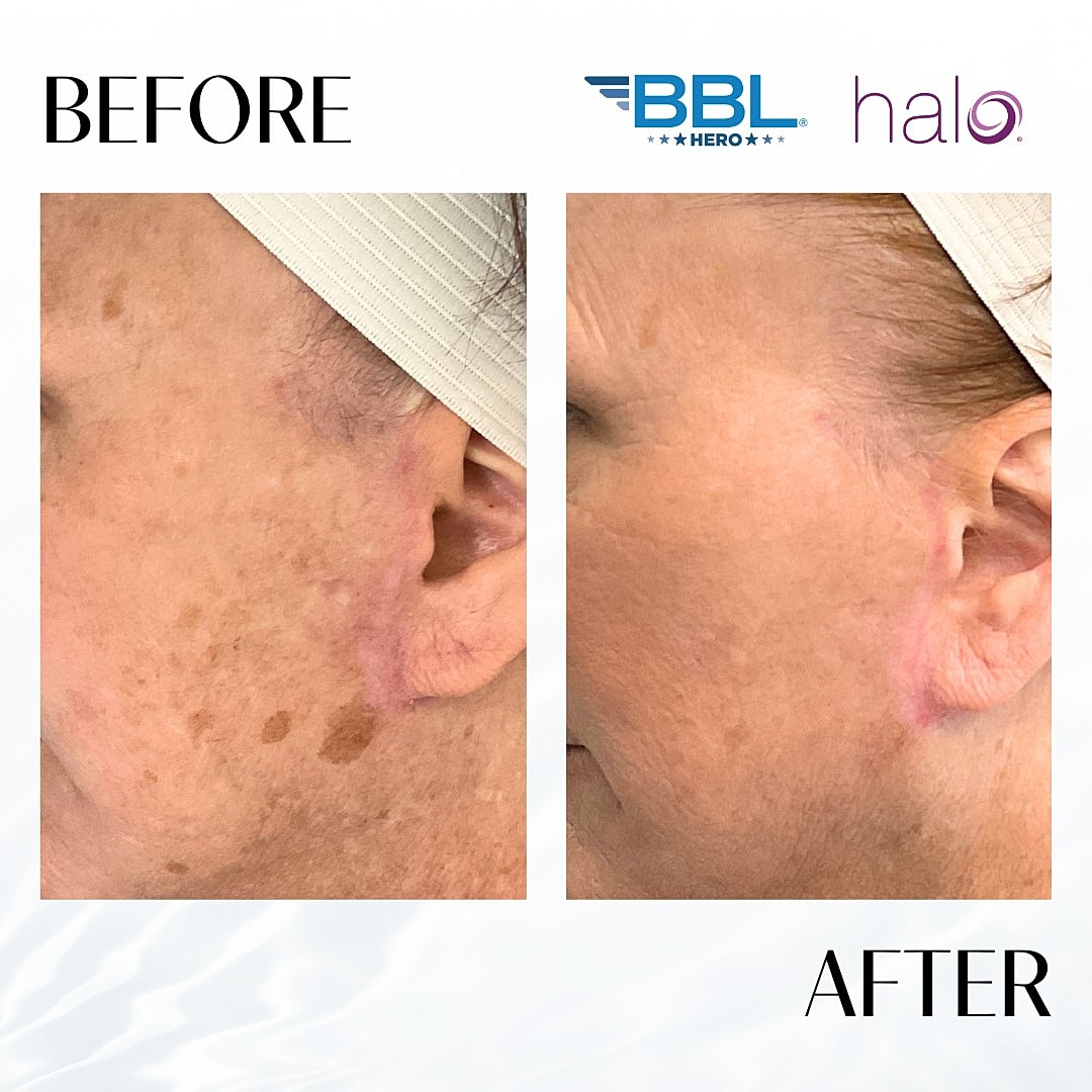 HALO Laser Before & After