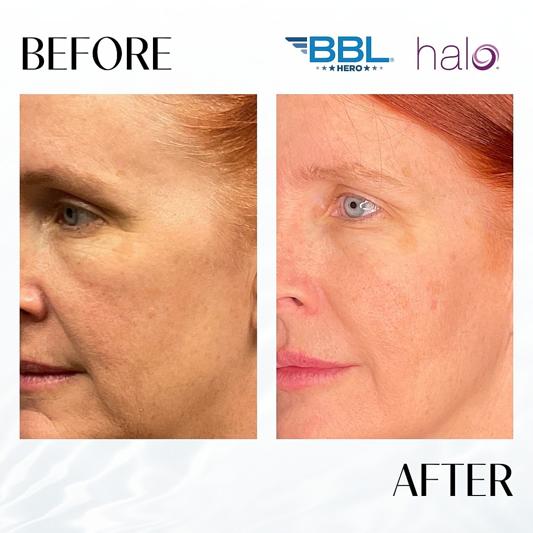 Halo Laser Before & After