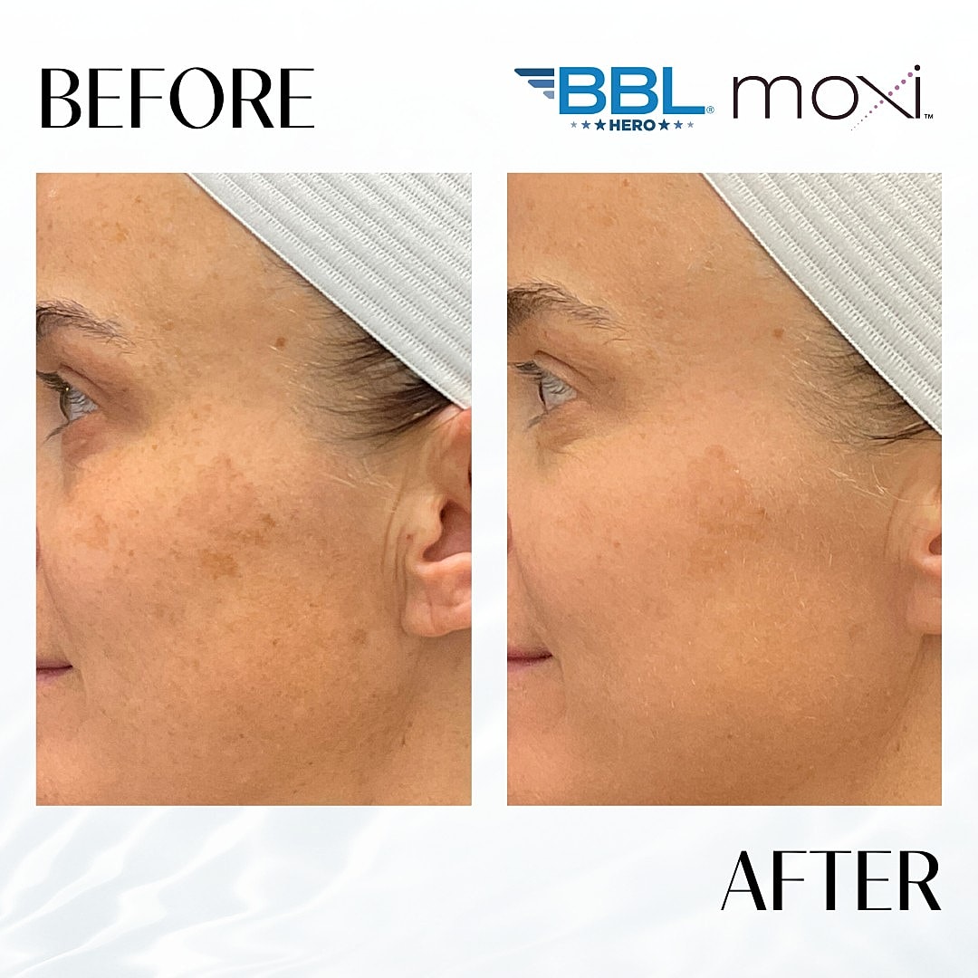 Moxi Laser Before & After