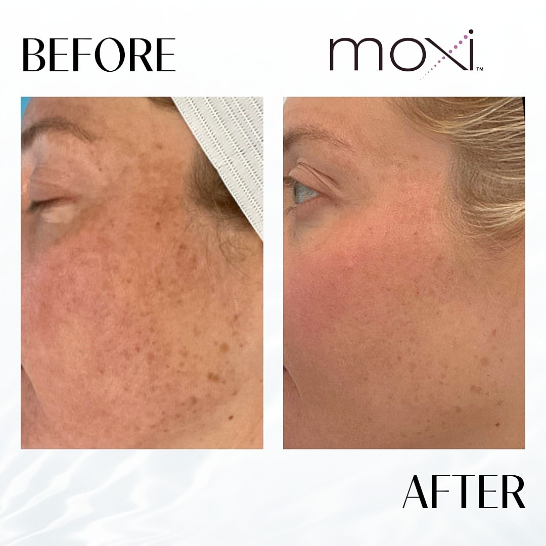 MOXI Laser Before & After