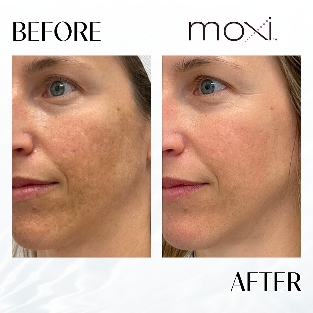 MOXI Laser Before & After