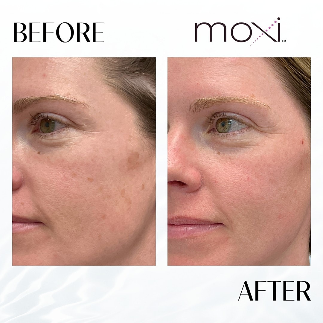 MOXI Laser Before & After