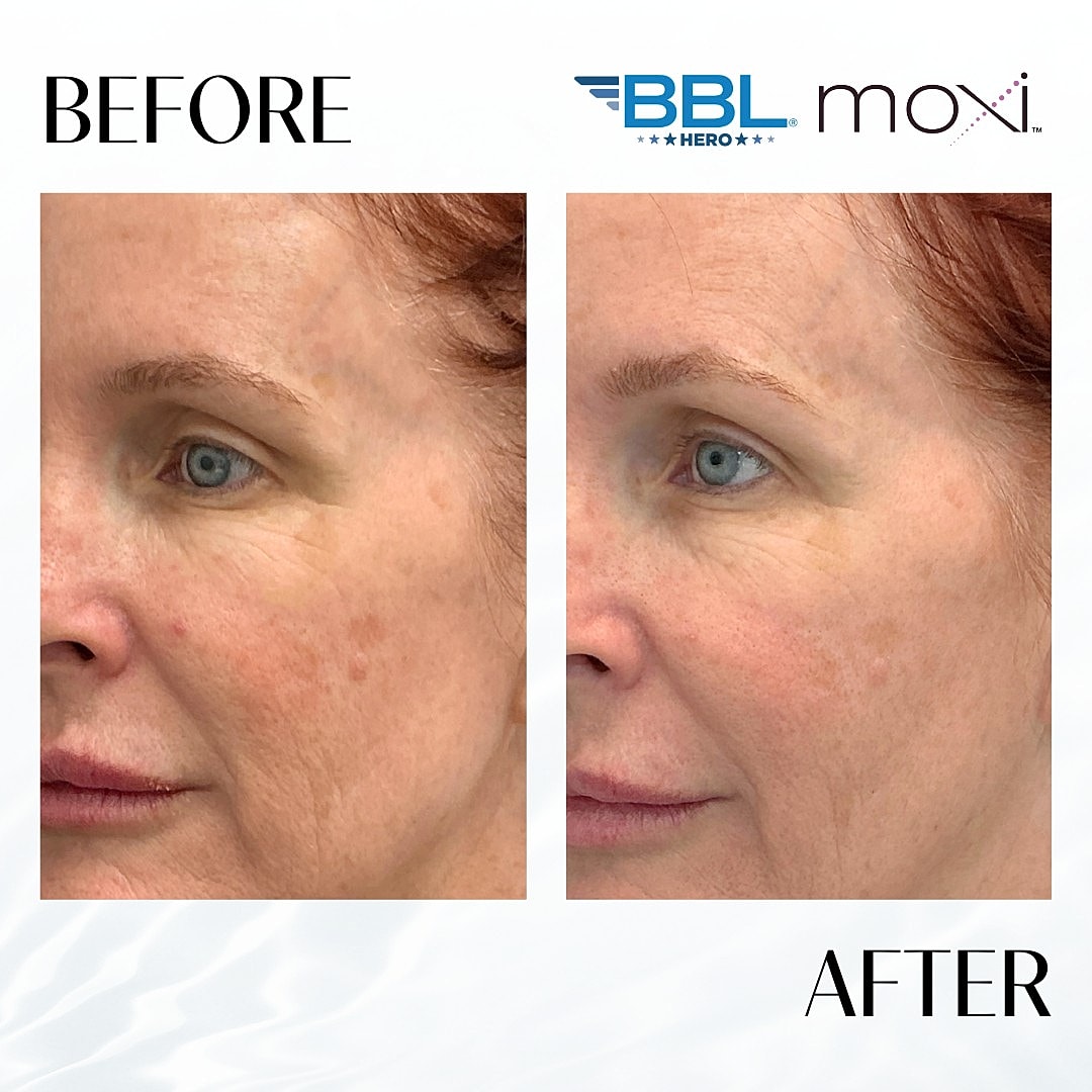 MOXI Laser Before & After