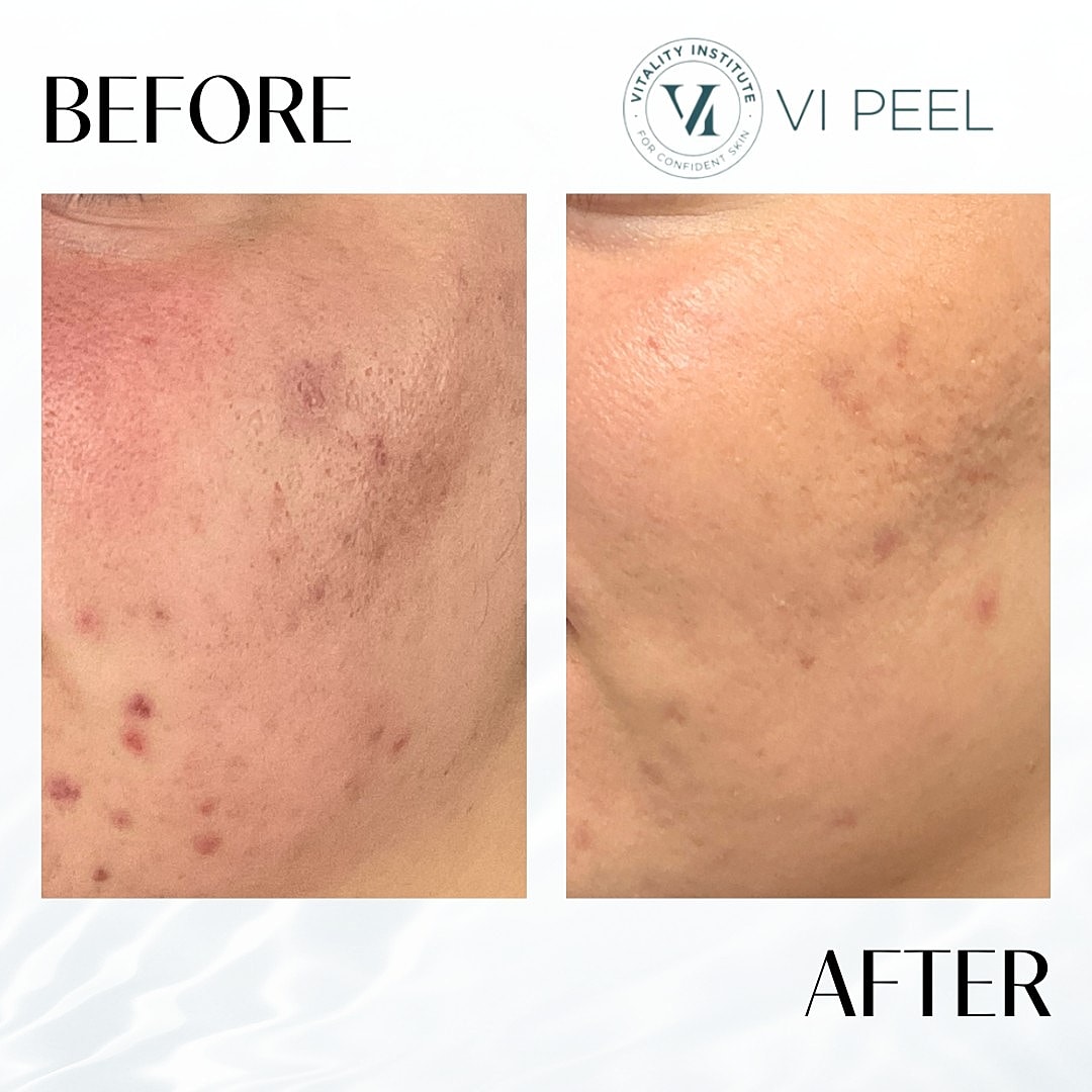 VI Peel Before & After