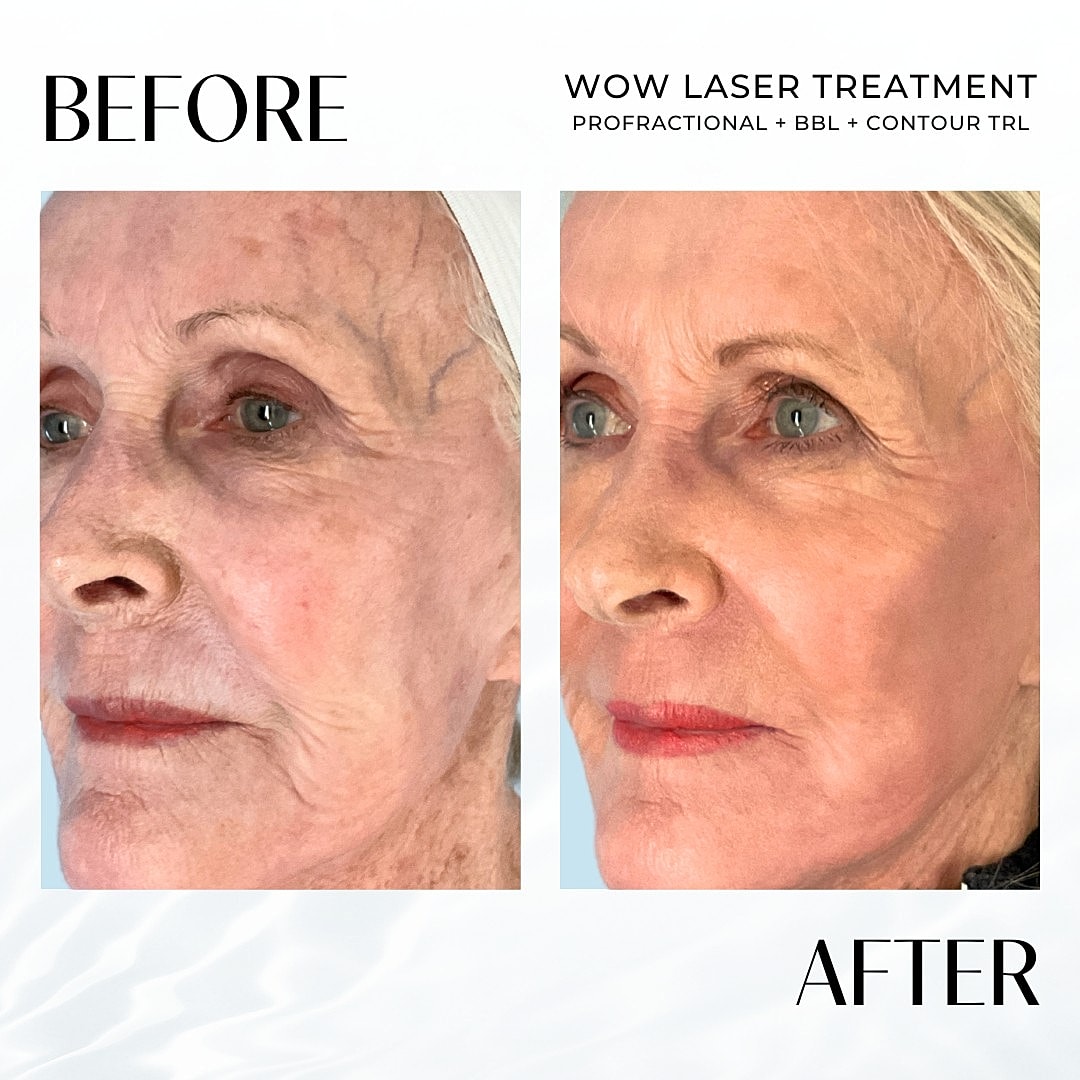 Laser Resurfacing (Wow) Before & After