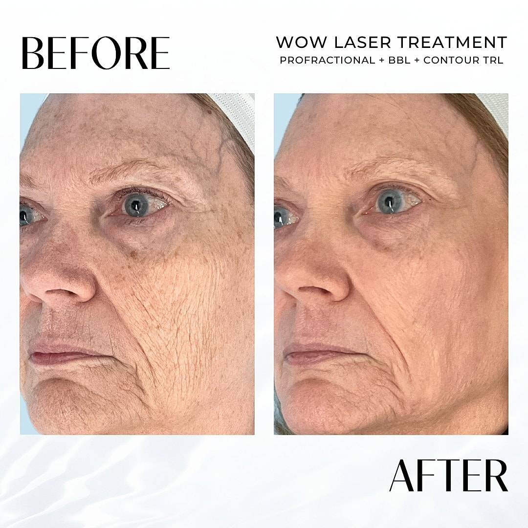 Laser Resurfacing (Wow) Before & After