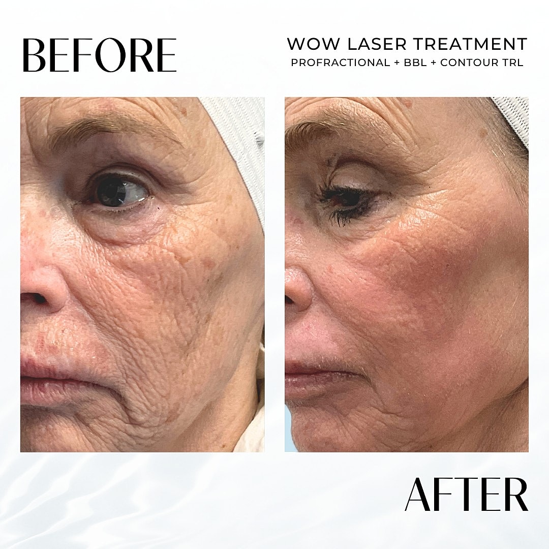 Laser Resurfacing (Wow) Before & After