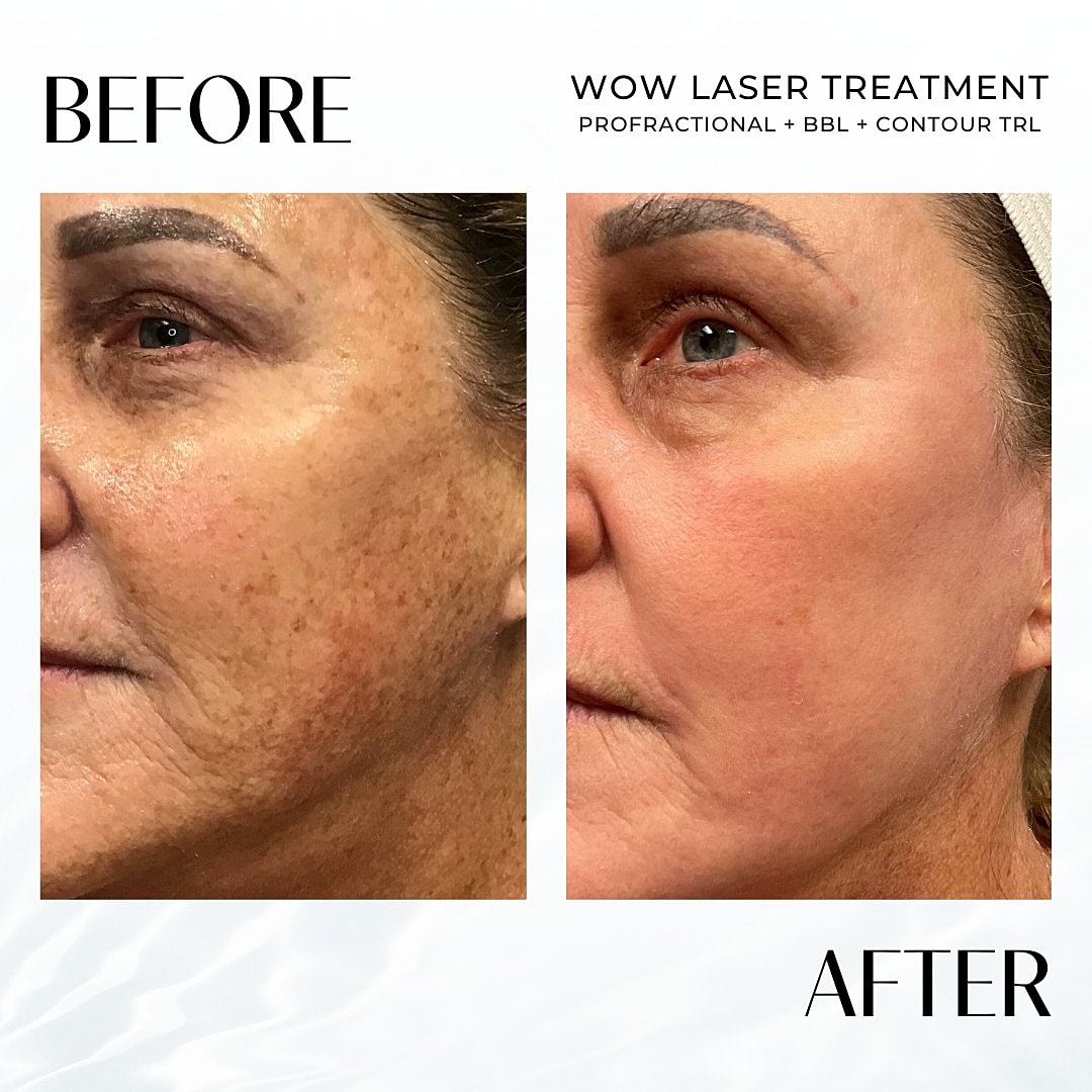 Laser Resurfacing (Wow) Before & After