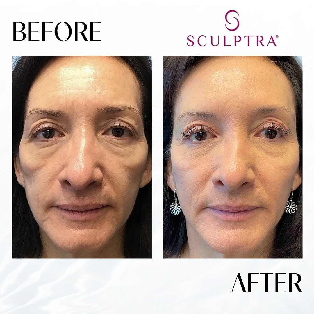 Sculptra Before & After