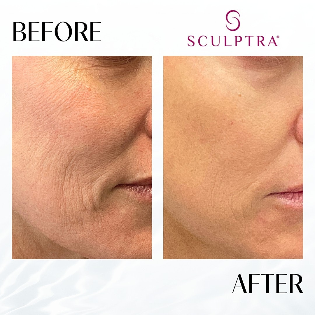 Sculptra Before & After